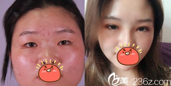 宁波珀悦金式伦做双眼皮<span style=