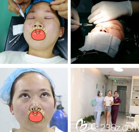 杭州康森医美做双眼皮手术过程