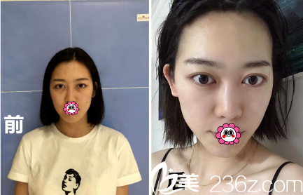 贵州利美康美肤案例效果对比