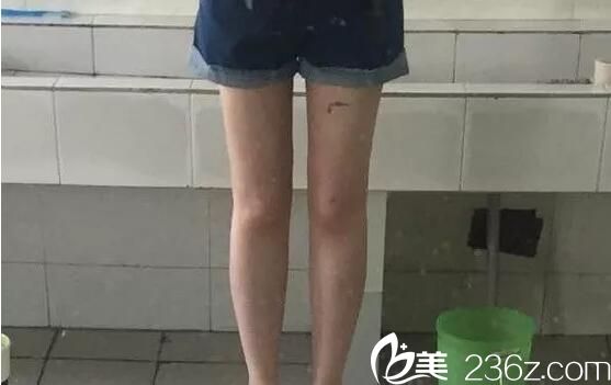 在电梯广告的指引下来到武汉欧兰尚美做了大腿吸脂 一个月后就恢复到我想要的效果
