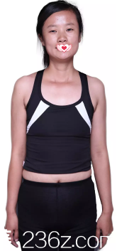 术前单眼皮、鼻子塌、胸部平坦 术前单眼皮、鼻子塌、胸部平坦