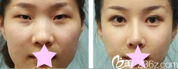 全切双眼皮案例效果对比图 全切双眼皮案例效果对比图
