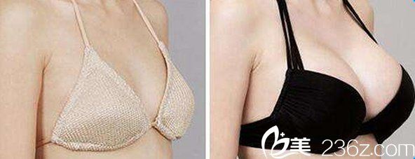 李烈医生自体脂肪隆胸效果案例 李烈医生自体脂肪隆胸效果案例