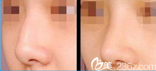 成都恒博鼻部整形对比图 成都恒博鼻部整形对比图