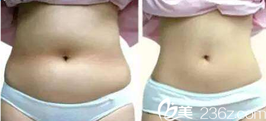 恒博整形医院腰部吸脂手术案例 恒博整形医院腰部吸脂手术案例