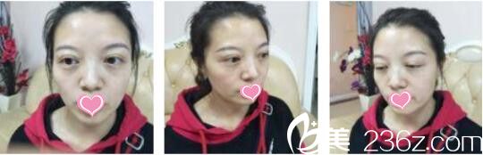 上海美莱医疗美容医院杜园园外切去眼袋真人案例术后第三天