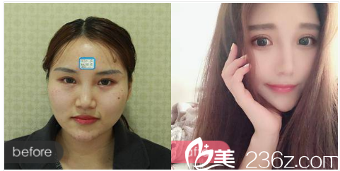 珠海艾瑞整形医院祝小伟做的双眼皮<span style= 珠海艾瑞整形医院祝小伟做的双眼皮<span style=