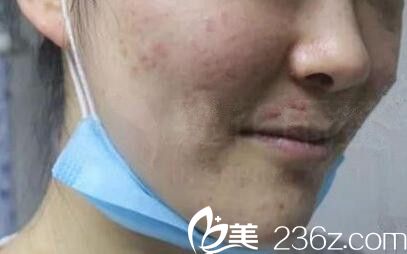 满脸痘痘痤疮的样子 满脸痘痘痤疮的样子