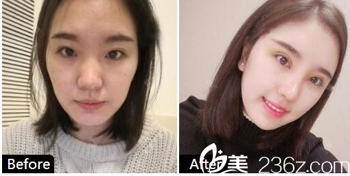 珠海艾瑞祝小伟做的做的隆鼻<span style= 珠海艾瑞祝小伟做的做的隆鼻<span style=