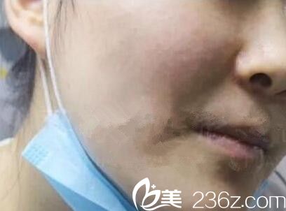 在郑州梨花雨做了彩光嫩肤去痤疮和痘印后 肌肤回归17岁状态