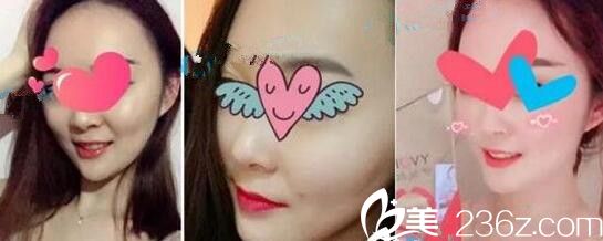 郑州梨花雨做激光祛痘嫩肤案例 郑州梨花雨做激光祛痘嫩肤案例