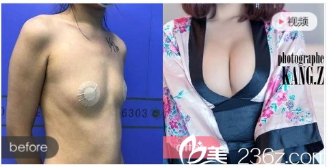 珠海艾瑞整形医院祝小伟做的隆胸<span style= 珠海艾瑞整形医院祝小伟做的隆胸<span style=