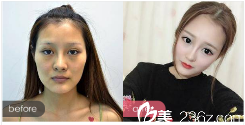 珠海艾瑞整形医院熊学俊做的自体脂肪填充<span style= 珠海艾瑞整形医院熊学俊做的自体脂肪填充<span style=