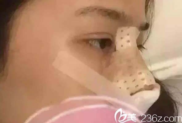 做完海鸥美鼻的术后即刻效果