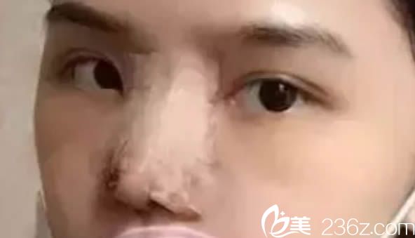 在福州台江整形医院做完隆鼻术后第4天的样子