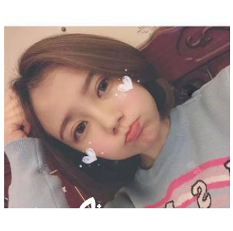 在珠海新颜整形医院做完双眼皮一个月效果