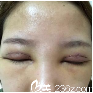 双眼皮术后两天