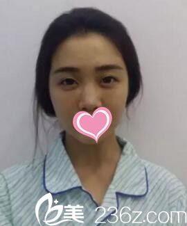 假体隆鼻术前照 假体隆鼻术前照