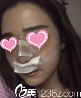 做假体隆鼻术后天样子 做假体隆鼻术后天样子