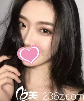 做假体隆鼻术后一个月时<span style= 做假体隆鼻术后一个月时<span style=