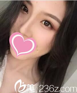永州博美整形医院怎么样？看我找做的假体隆鼻术后三个月恢复效果！