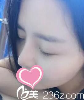 做假体隆鼻术后半个月<span style= 做假体隆鼻术后半个月<span style=