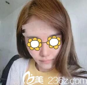 自体脂肪填充面部术后<span style=