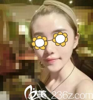 在永州博美做自体脂肪填充全脸术后一周<span style=