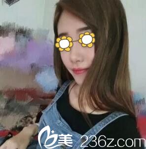 自体脂肪填充全脸术后半个月<span style=