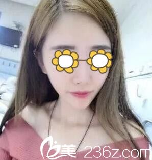 真人案例：永州博美整形美容医院自体脂肪填充面部恢复全过程前后对比照片分享
