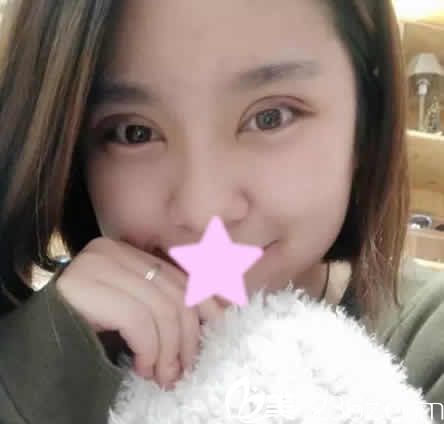 我在运城丽都做切开双眼皮修复和开眼角后第7天照片