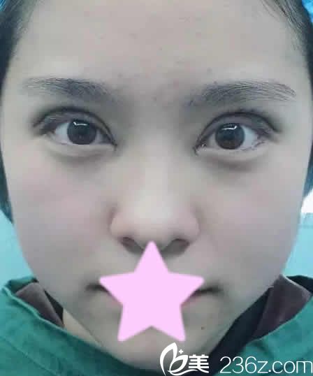 我在运城丽都做全切双眼皮修复加开眼角后第3天照片