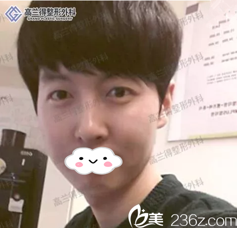 韩国高兰得整形外科双眼皮+鼻部整形+脂肪填充真人案例，手术一个月前后对比