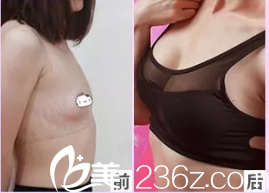 维多利亚隆胸案例 维多利亚隆胸案例