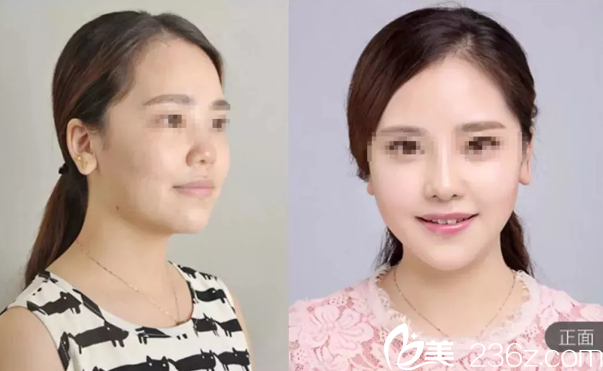 张家口维多利亚鼻综合案例 张家口维多利亚鼻综合案例