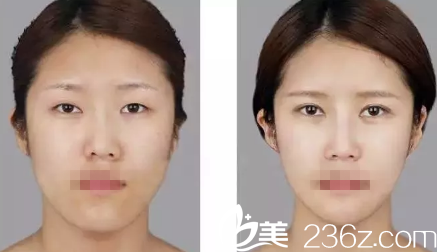 张家口维多利亚双眼皮案例 张家口维多利亚双眼皮案例