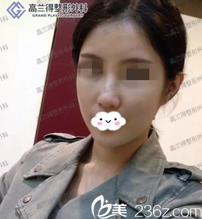 经过韩国id和韩国高兰得对比，较终还是选择了高兰得做面部轮廓整形，看我的术后三个月的恢复效果