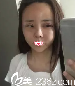 刚做完眼鼻综合面部肿胀 刚做完眼鼻综合面部肿胀