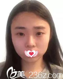 术前是无神单眼皮和塌鼻子 术前是无神单眼皮和塌鼻子