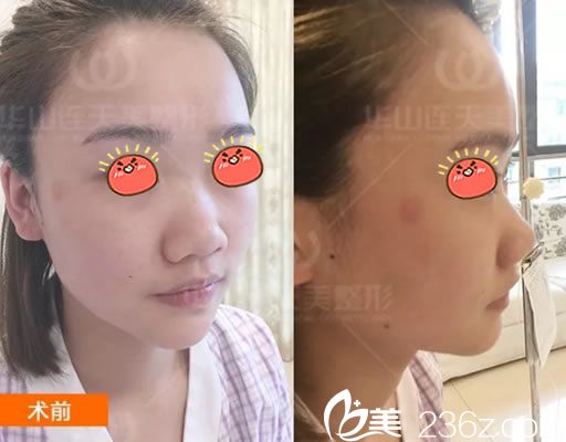 在杭州连天美做隆鼻前 在杭州连天美做隆鼻前