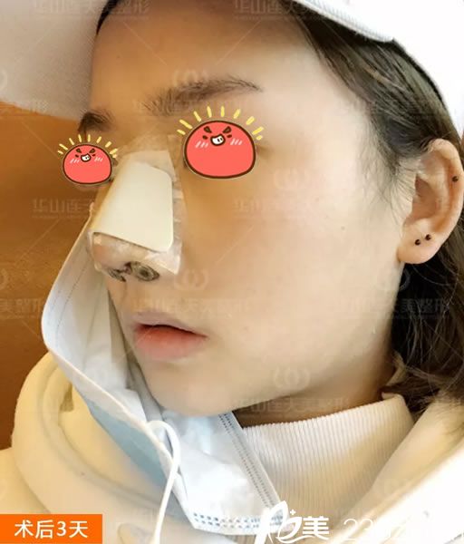 做完肋软骨隆鼻3天恢复照 做完肋软骨隆鼻3天恢复照