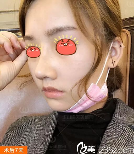 做完肋软骨鼻综合隆鼻7天效果图 做完肋软骨鼻综合隆鼻7天效果图