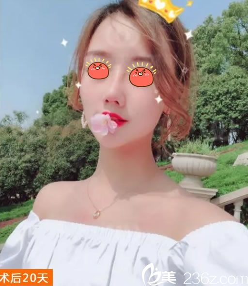 杭州连天美<!--<i data=20240703-sp></i>-->隆鼻案例20天效果 杭州连天美<!--<i data=20240703-sp></i>-->隆鼻案例20天效果