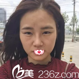 术前是内双眼、塌鼻子和凹陷的面部 术前是内双眼、塌鼻子和凹陷的面部