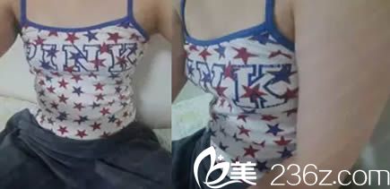 韩国珠儿丽腰腹吸脂+假体隆胸术前照 韩国珠儿丽腰腹吸脂+假体隆胸术前照