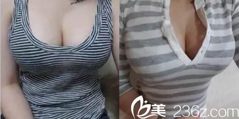 韩国珠儿丽假体隆胸和吸脂瘦身术后两个月照