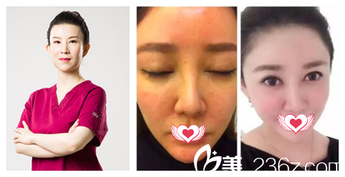 石家庄天伊美张斌医生做激光祛斑案例 石家庄天伊美张斌医生做激光祛斑案例