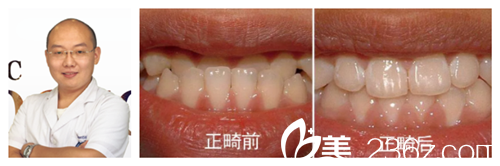 天伊美主任李功做正畸矫正案例 天伊美主任李功做正畸矫正案例