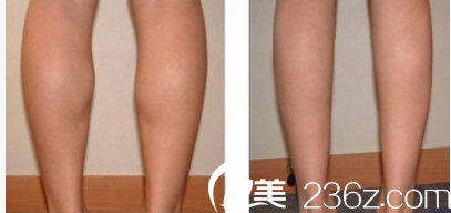 北京华韩谌燃瘦脸除皱瘦腿案例 北京华韩谌燃瘦脸除皱瘦腿案例