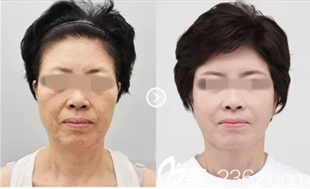 冯院长小帽子除皱抗衰术效果图 冯院长小帽子除皱抗衰术效果图